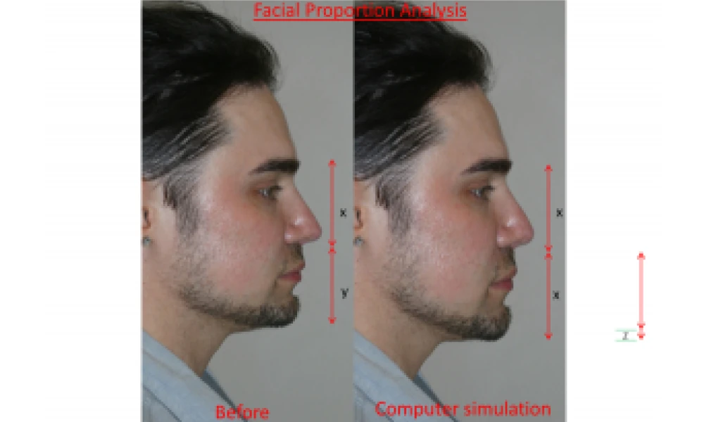 Clinical photo from Chad's cosmetic jaw surgery case